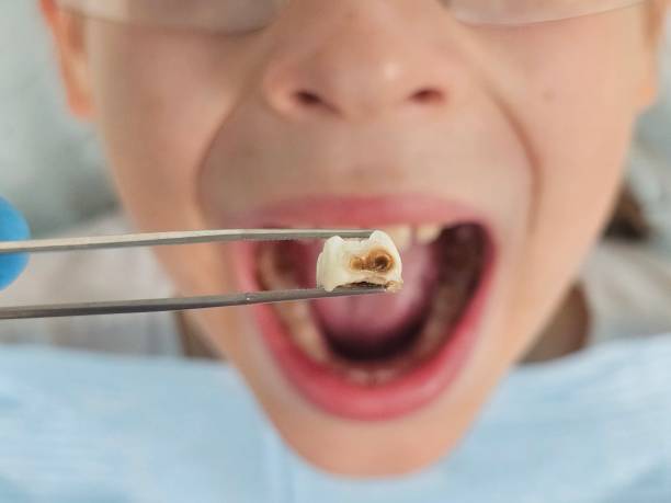 Best Emergency Wisdom Teeth Removal in Wahese, NC